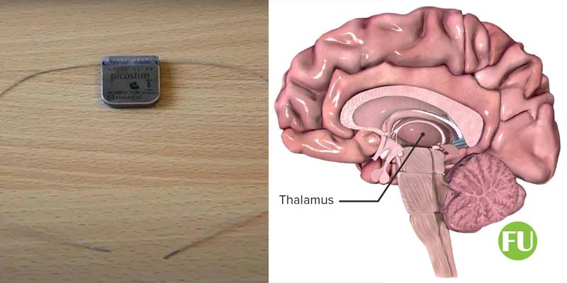 Un piccolo neurostimolatore può guarire l’epilessia grave