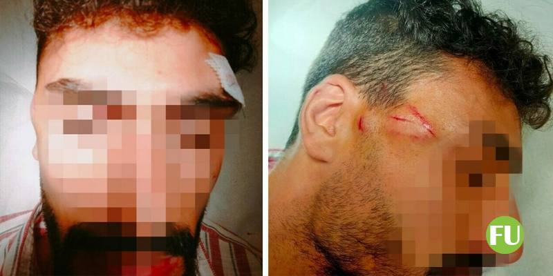 Ragazzo picchiato a Napoli dopo un incidente: mi hanno spaccato la testa